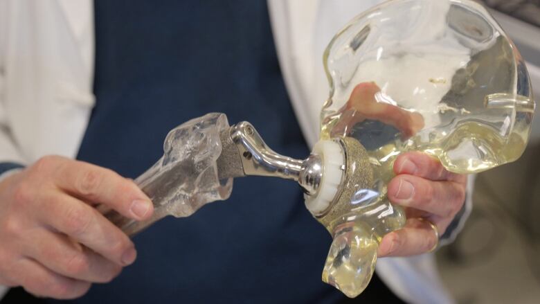  A doctor holds a model of a cementless hip replacement.