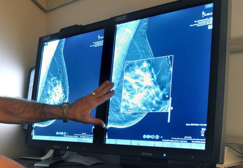 a hand pointing to a computer screen showing a mammogram