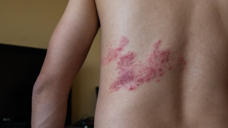 A man with a rash on his back