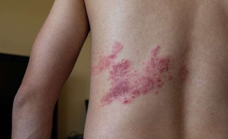 A man with a rash on his back