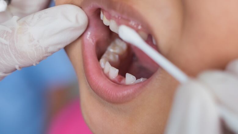 A closeup shot of a child's mouth is shown, with gloved hands rubbing a Q-Tip over teeth.