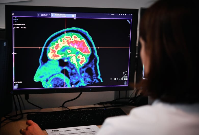 A brain scan is seen on a computer monitor. 