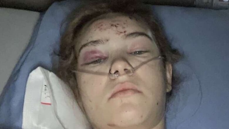 A woman lies in a hospital bed with gashes on her face and a swollen eye.