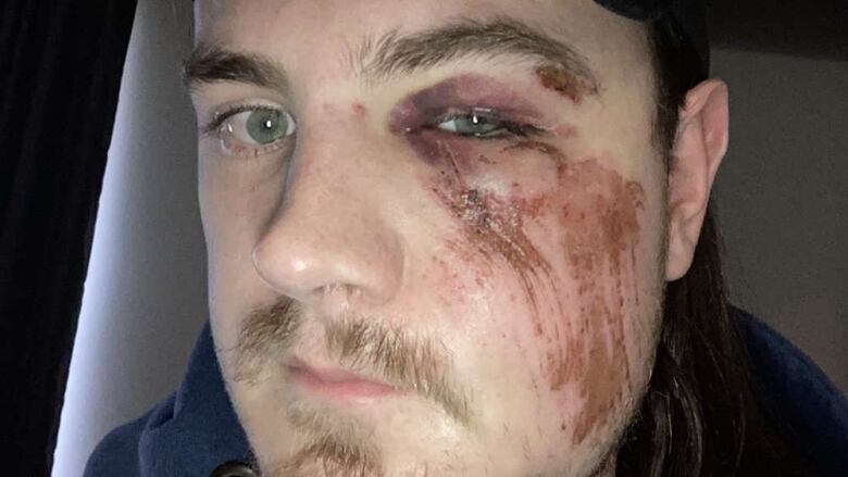 A picture of Quebec City resident Patrick Belanger showing the facial injuries he sustained in a fall while on vacation in British Columbia. Belanger says he was denied surgery at Royal Inland Hospital in Kamloops, B.C., where a surgeon told him he couldn't do the operation because Quebec 'doesn't pay.' 