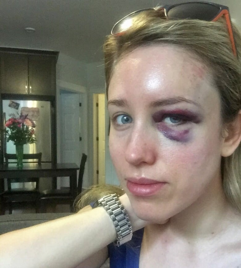 A woman with a black eye.