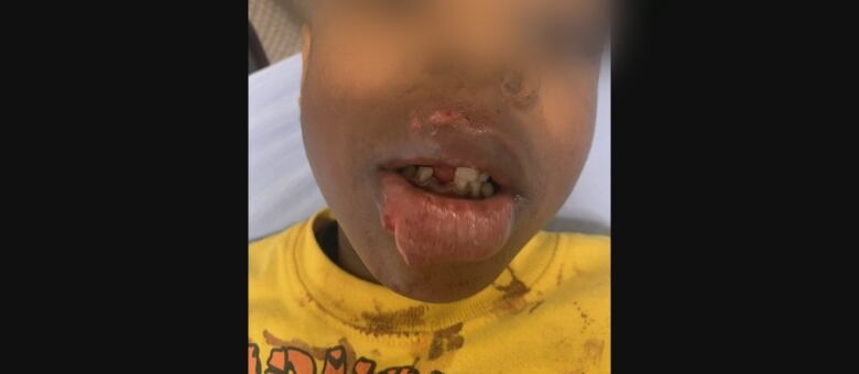 Child's face showing wounds to upper and lower lips and missing tooth. 