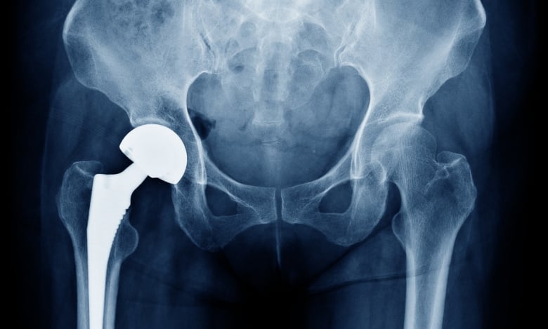 X-ray scan image of hip joints with orthopedic hip joint replacement.