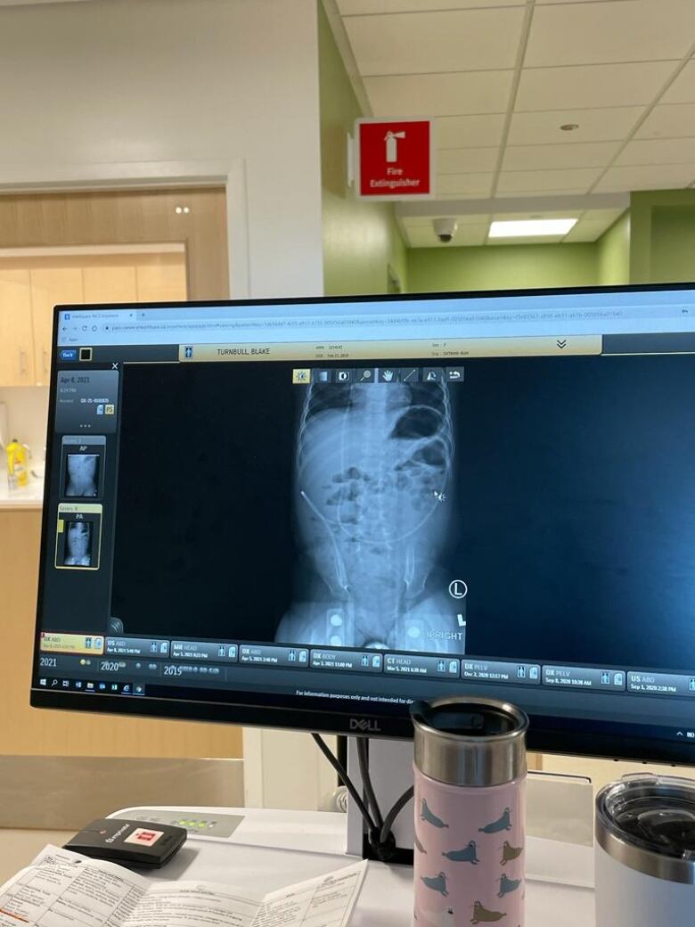 An X-ray of abdominal cavity displayed on a monitor screen.