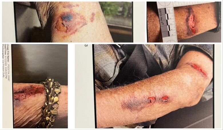 Four photos of cuts and bruises on elderly people's arms.