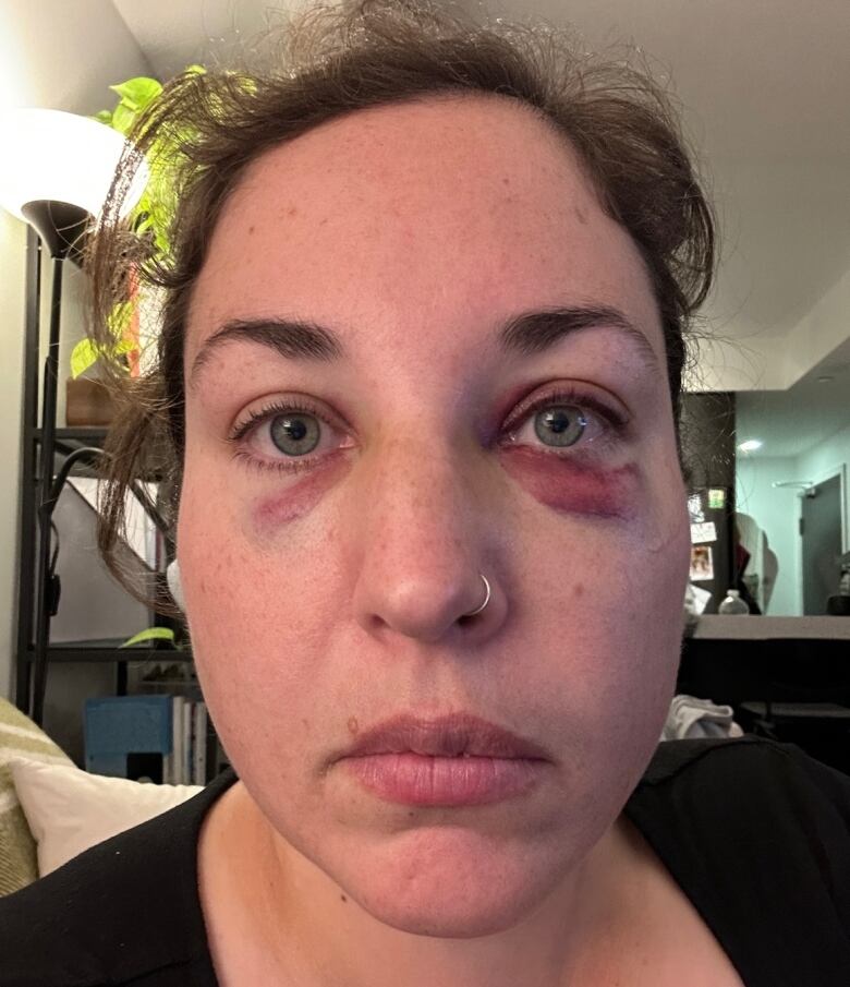 Woman with two black eyes.