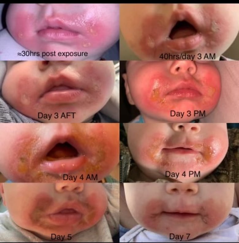 Photos of skin rashes on a baby's face.