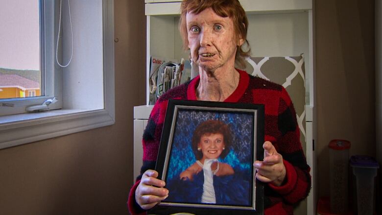 A woman with scleroderma holds a picture of her younger self.