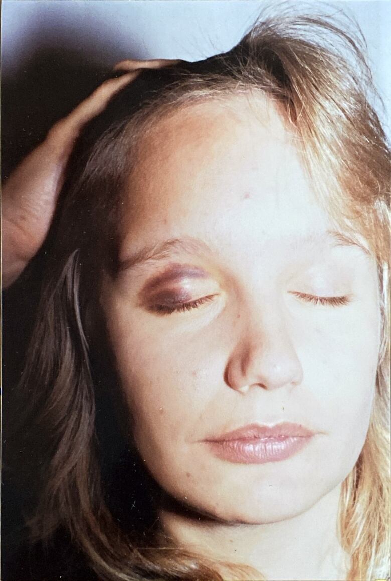 A white woman shows off a black eye in a police photo.