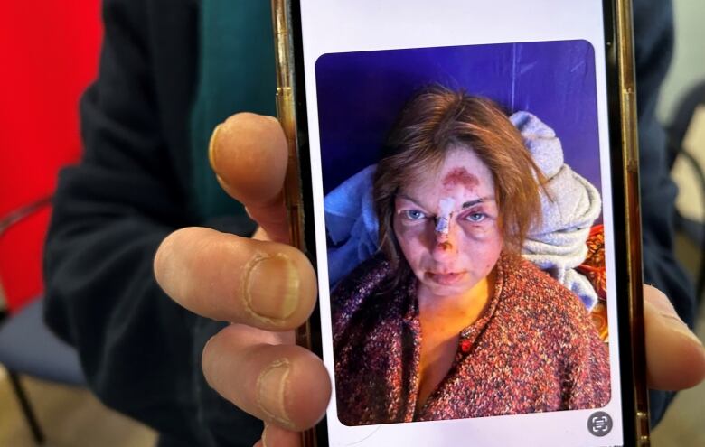 Kate Lee holds her phone with a photo of her injuries.