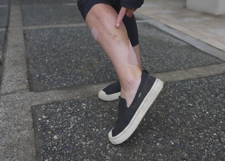 A woman points to long band-aids on her leg.