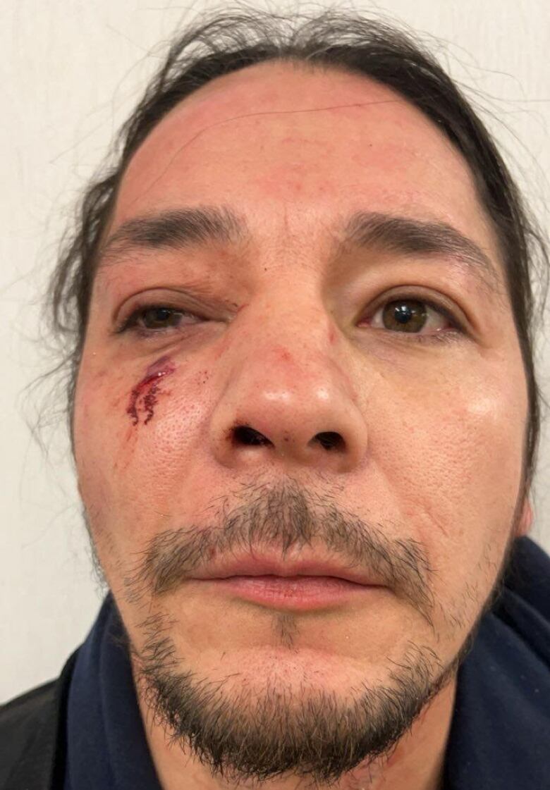 A man with a cheek and eye injury poses for a picture.