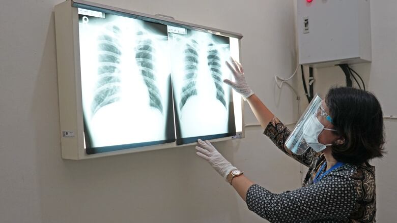 A woman wearing a medical mask and a face shield looks at two brigtly illuminated X-rays of a person's chest.