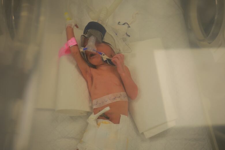 A premature baby is pictured inside an incubator, connected to a ventilator.