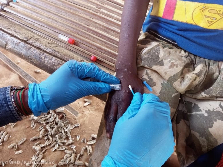 Blue gloves hold a swab and a test tube near a pustule on an arm, ready to be put into the test tube. 