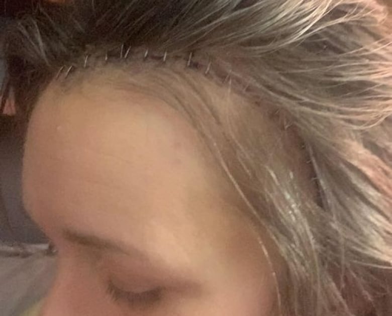 Pictured is the top of a woman's hairline with her eye in profile cast down, and her hair held up so surgical staples can be seen running from her forehead to her ear.