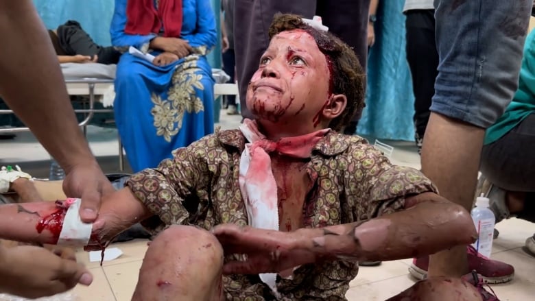 A girl with blood and burn marks all over her arms sits on the floor of a hospital.